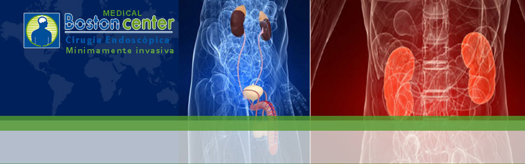 Tratamiento de cálculos por endoscopía y litoptricia extracorpórea